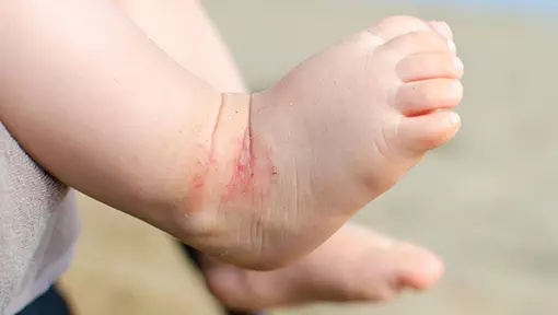 Photo of baby with eczema on their ankle