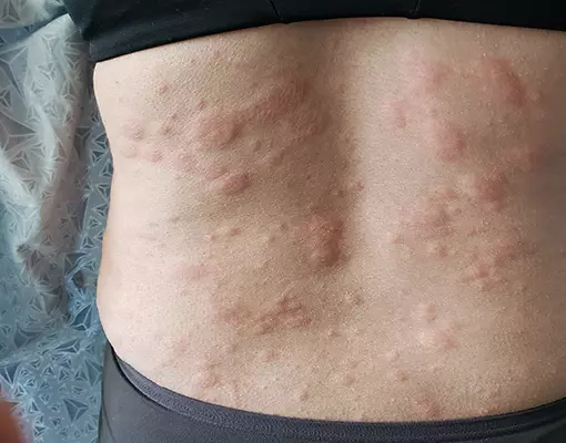 Photo showing what hives look like