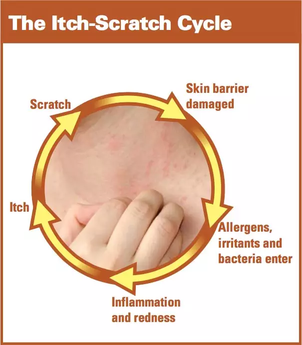Itch scratch cycle chart showing how it goes from itch to scratch to skin damaged to allergens or bacteria entering to inflammation and redness back to itch again.