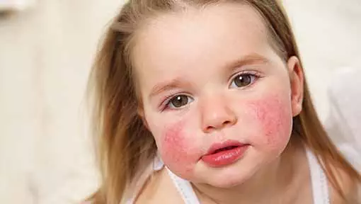 Photo of young girl with a rash on her face