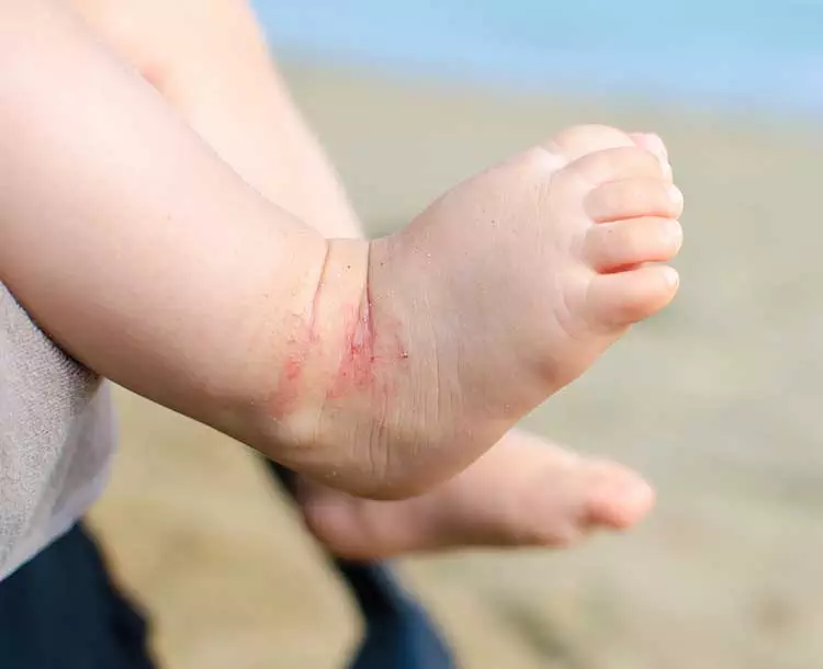 Photo of baby legs with baby bare feet. The infant has a rash of hives on their ankle