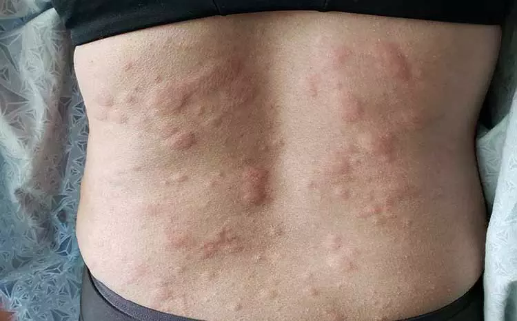 Person with severe hives on their back.