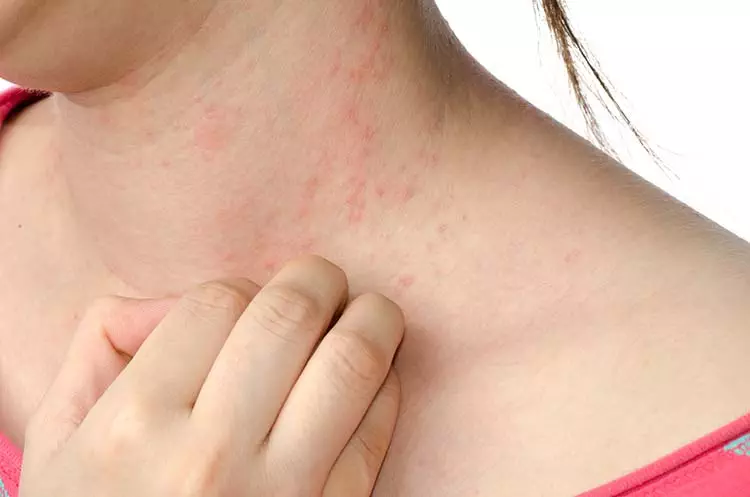Image of a young woman's neck with a breakout of hives.