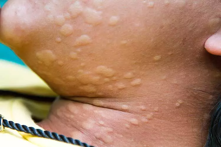 Image of a southeast Asian person's neck with a breakout of hives.
