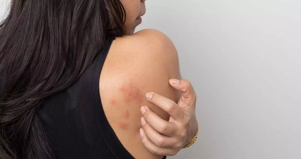 Image of a woman with hives on her back shoulder