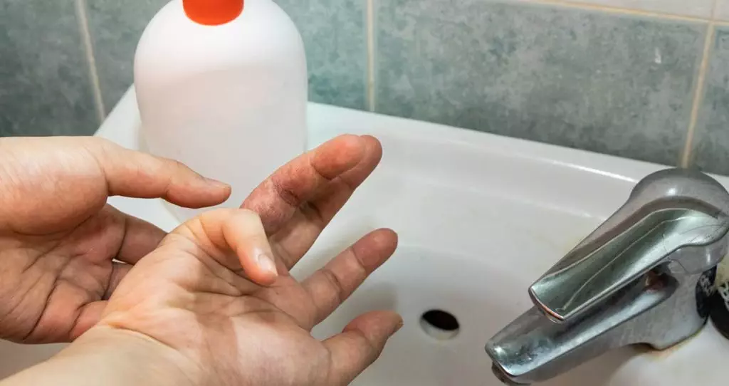 A man's hands over a sink with a bottle of liquid soap on the sink. The man has his fingers spread apart to show he has eczema and is trying to wash his hands without issue.