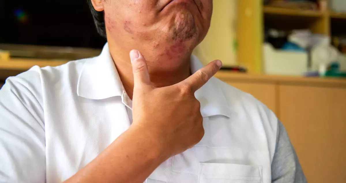Man with rare hives on his chin and cheeks. He is holding up his hand towards his chin, pointing out his discomfort.