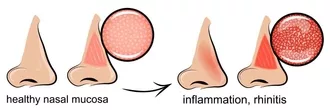 graphic of inflammation of the nasal mucosa