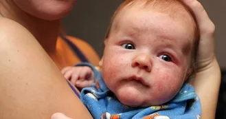 Baby with severe eczema on its face