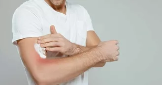 Man putting cream on his moderate eczema on the inside of his elbow