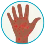 Circle icon with hand showing Chronic Idiopathic Urticaria.
